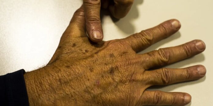 dezembro-laranja-alerta-para-a-prevencao-do-cancer-de-pele-no-brasil