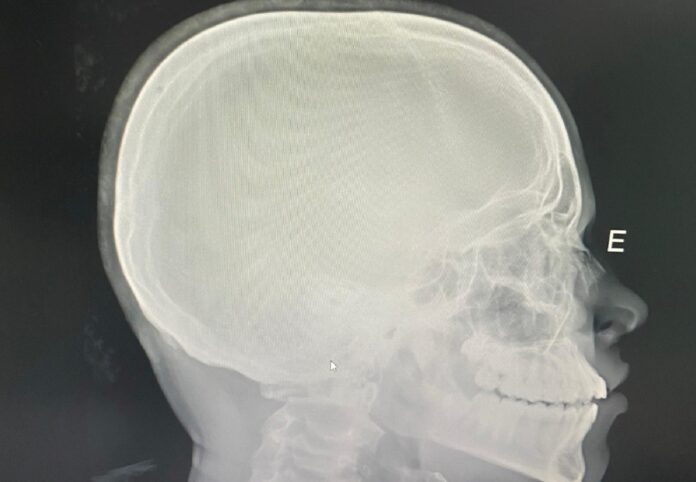 estudante-tem-nariz quebrado em-escola-publica-do-tocantins-e-familia-denuncia-ofensas-racistas