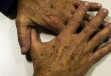 País deve registrar 9 mil novos casos de melanoma, nem sempre na pele pais-deve-registrar-9-mil-novos-casos-de-melanoma,-nem-sempre-na-pele