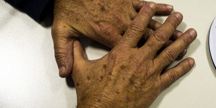 pais-deve-registrar-9-mil-novos-casos-de-melanoma,-nem-sempre-na-pele