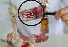 Muito frequente, câncer de intestino pode não apresentar sintomas muito-frequente,-cancer-de-intestino-pode-nao-apresentar-sintomas