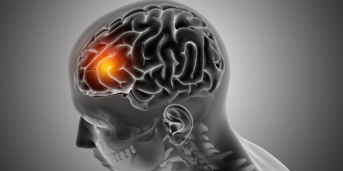 avc:-neurologista-explica-como-identificar-os-primeiros-sinais avc:-neurologista-explica-como-identificar-os-primeiros-sinais
